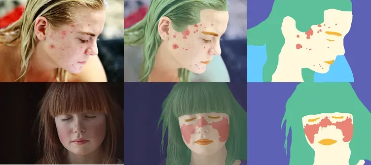 피부 병변 영역 시맨틱 세그멘테이션 가공